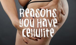 woman with cellulite on legs