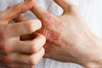 eczema on hands benefits black onion seed