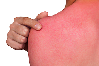 sunburn relief Pandan leaf health benefits 3